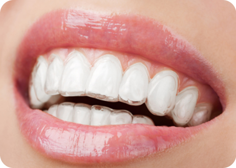 Invisible and transparent orthodontic device that is undetectable when worn and allows for normal daily activities without interference