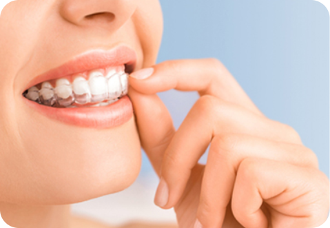 designed to minimize foreign body sensation and reduce oral cavity trauma when worn
